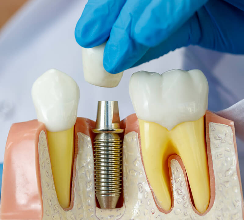 material usado em implantes dentários