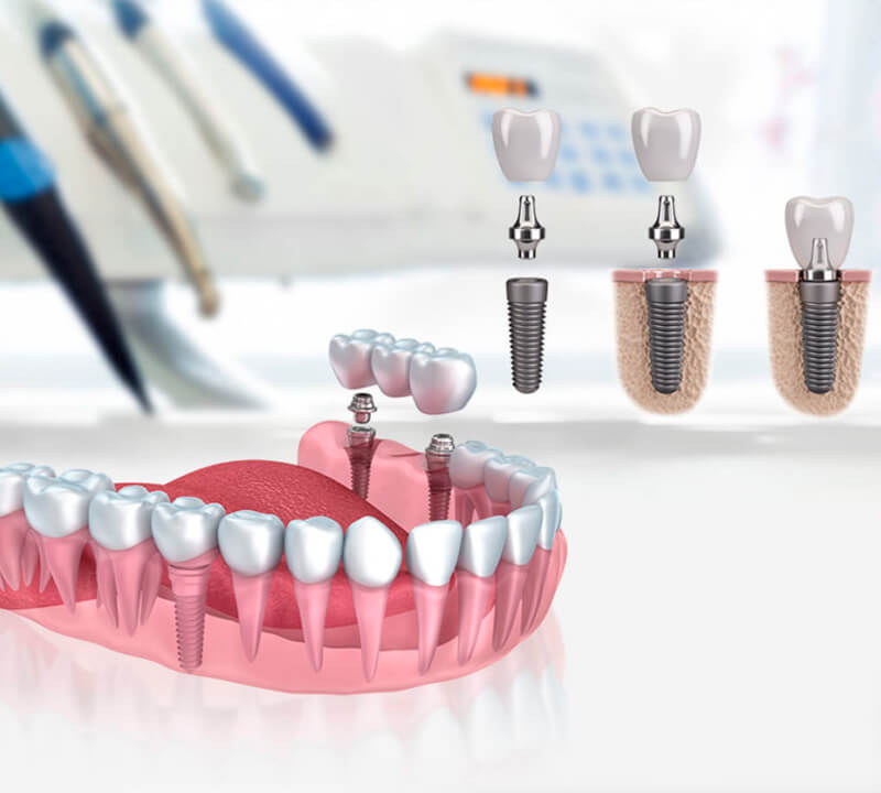 Onde são fixados os implantes dentários?