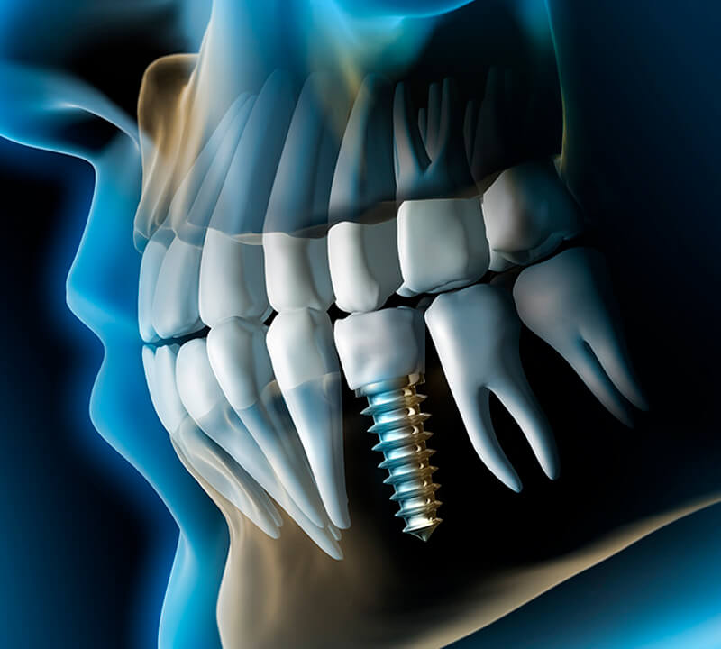 Implante Dentário – Pode haver rejeição?