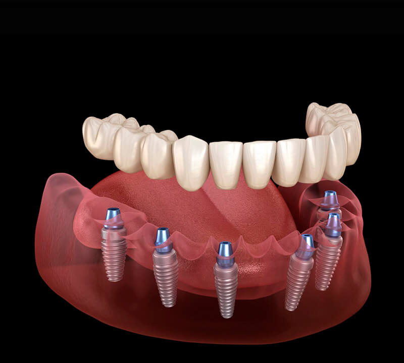 Implantes Dentários – Quanto tempo dura a cirurgia de instalação?