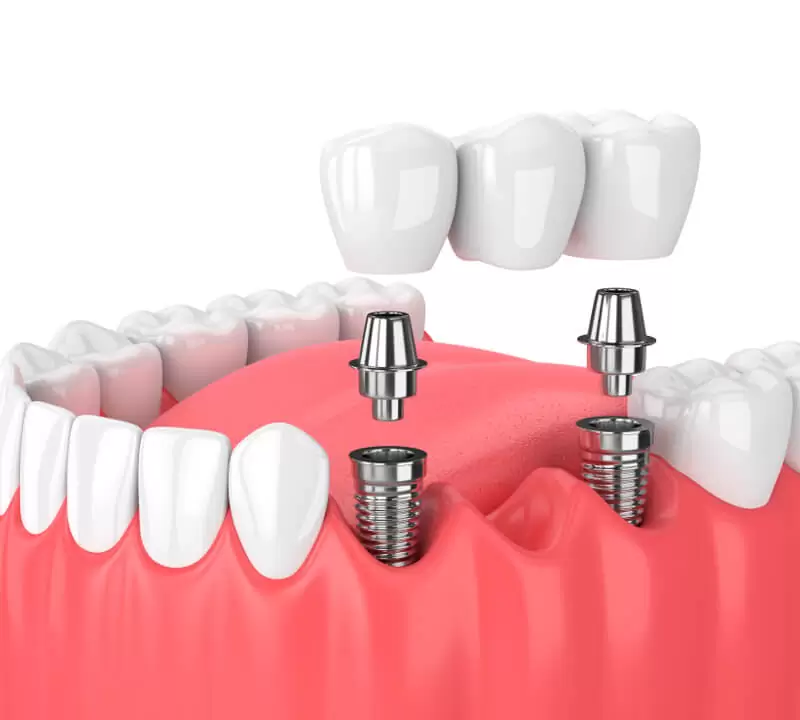 Dói fazer implante dentário