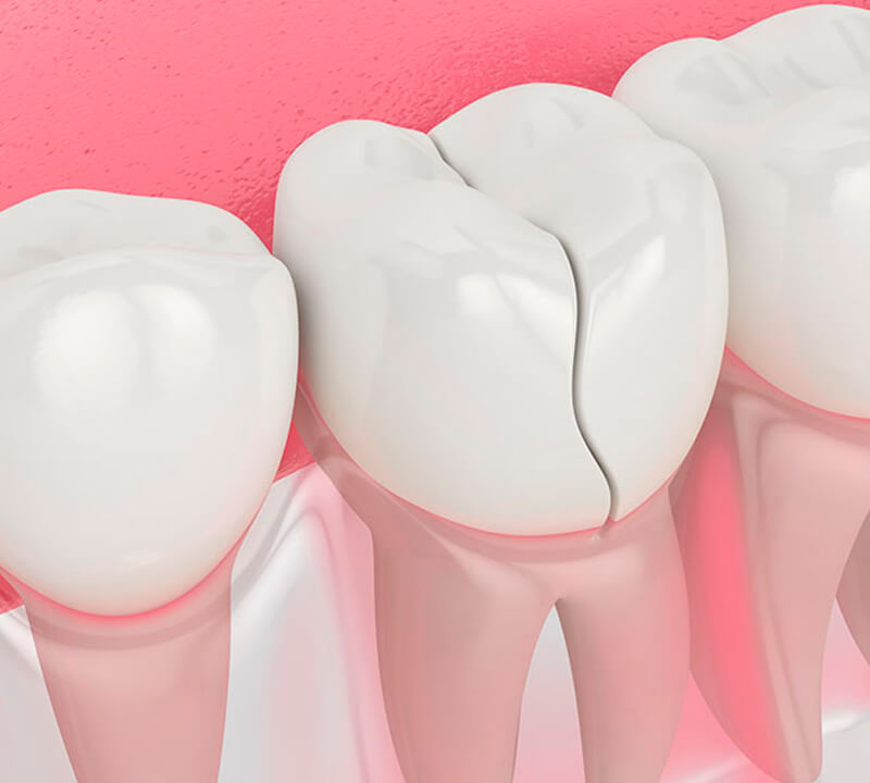 Dentes fraturados