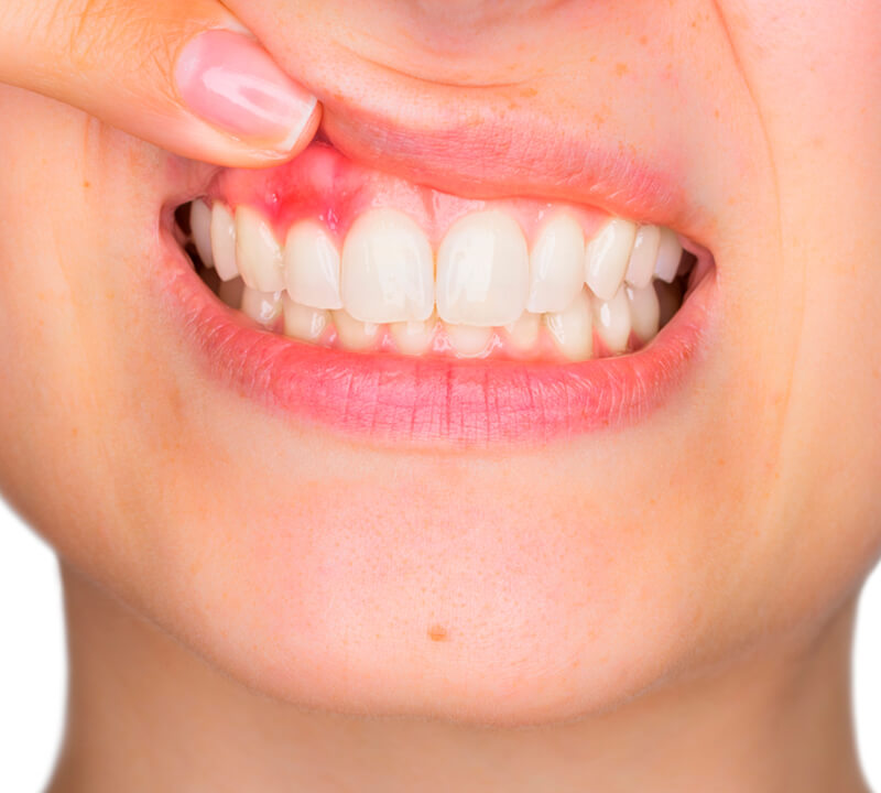 Doença periodontal pode agravar infecção pelo Coronavírus?