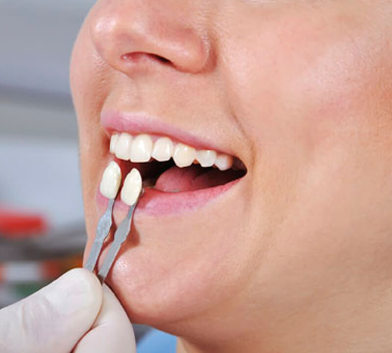 Lentes de contato dentais: Quais são as etapas do tratamento