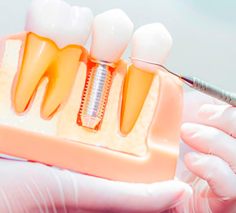 Técnica utilizada para indicar implantes dentários