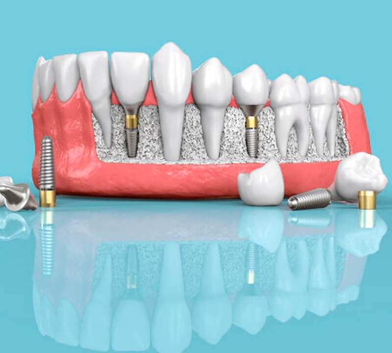 Preço do implante dentário pode definir qualidade?