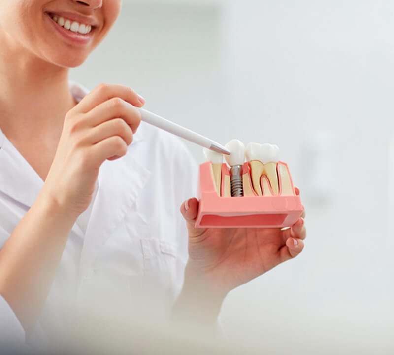 Curiosidades sobre Implantes dentários