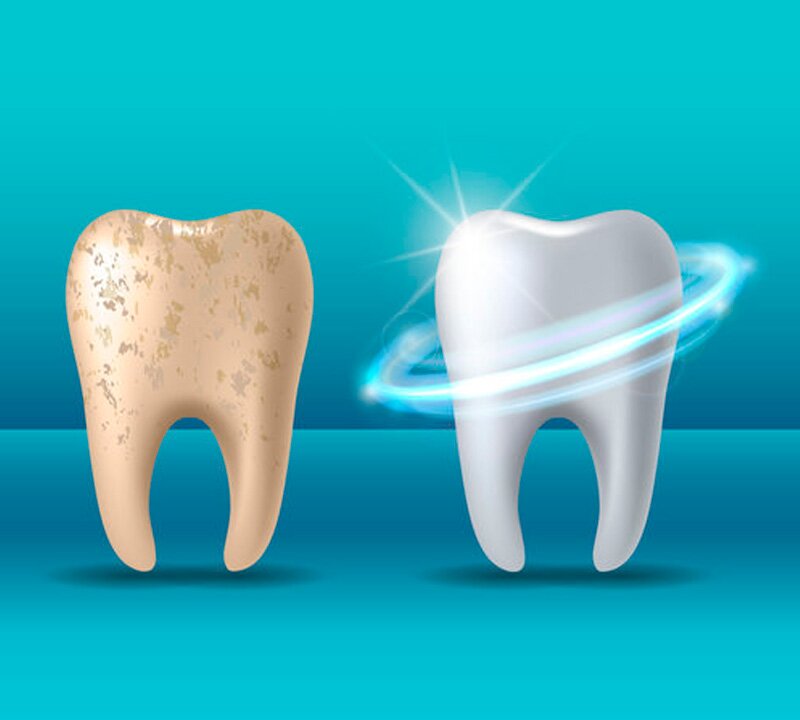 Desgaste dos esmaltes dos dentes