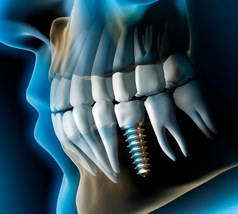 Chances de um implante dentário dar errado