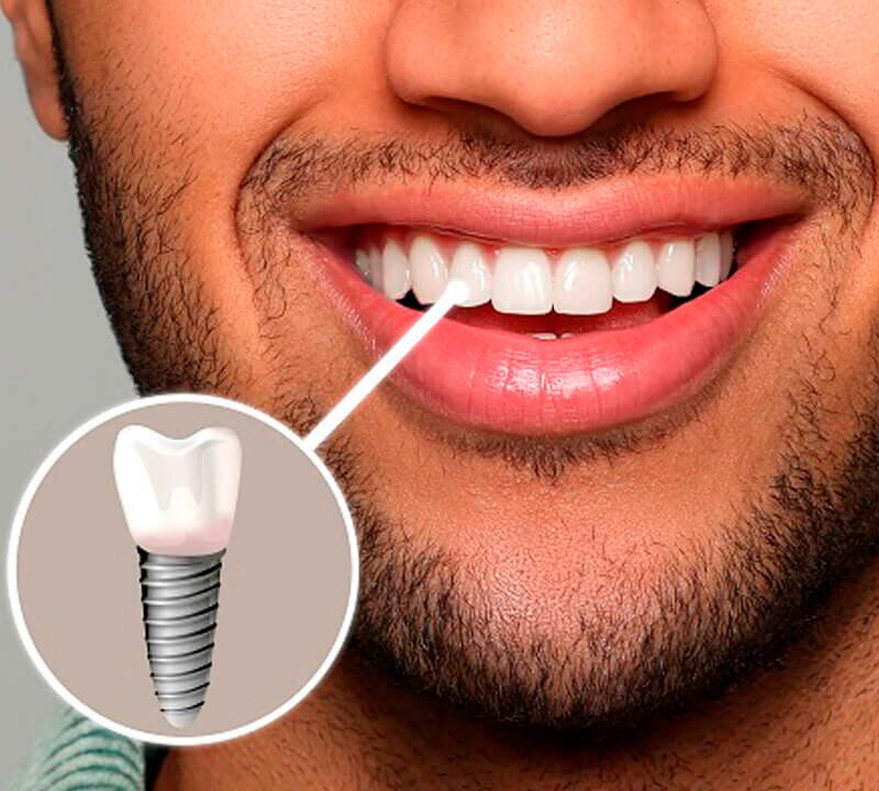 Implante e dente no mesmo dia