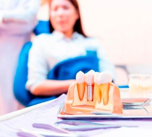 cuidar dos implantes dentários