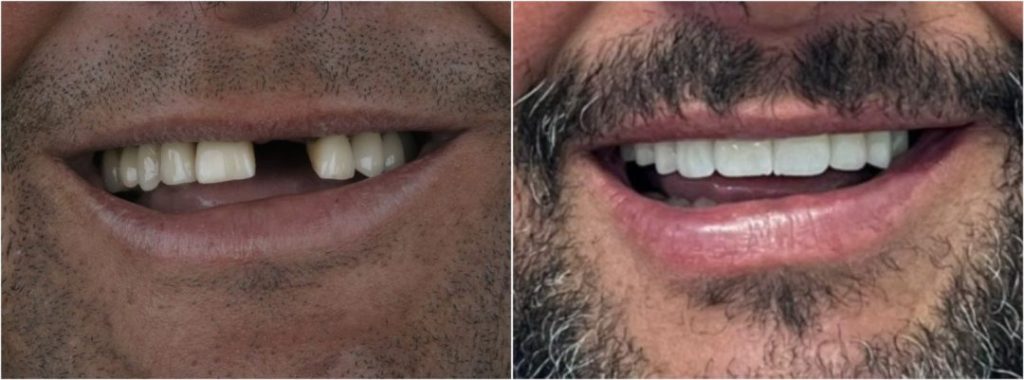 Etapas de um implante dentário