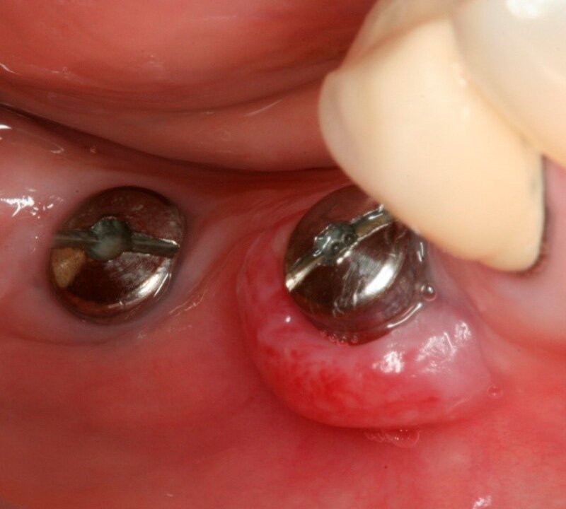 Implante Dentários Manutenção São Paulo