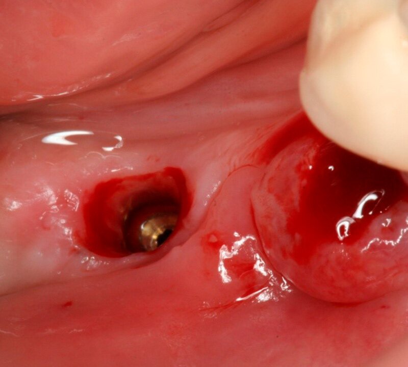 Implante Dentários Manutenção São Paulo