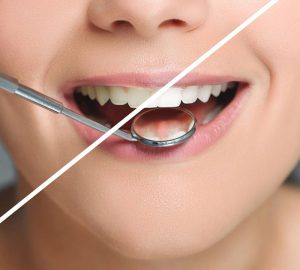 Clareamento Dental - Mooca - SP