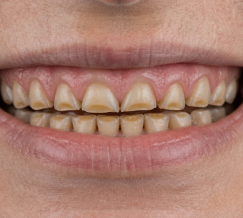 Dentista - Mooca -Desgaste Dentário