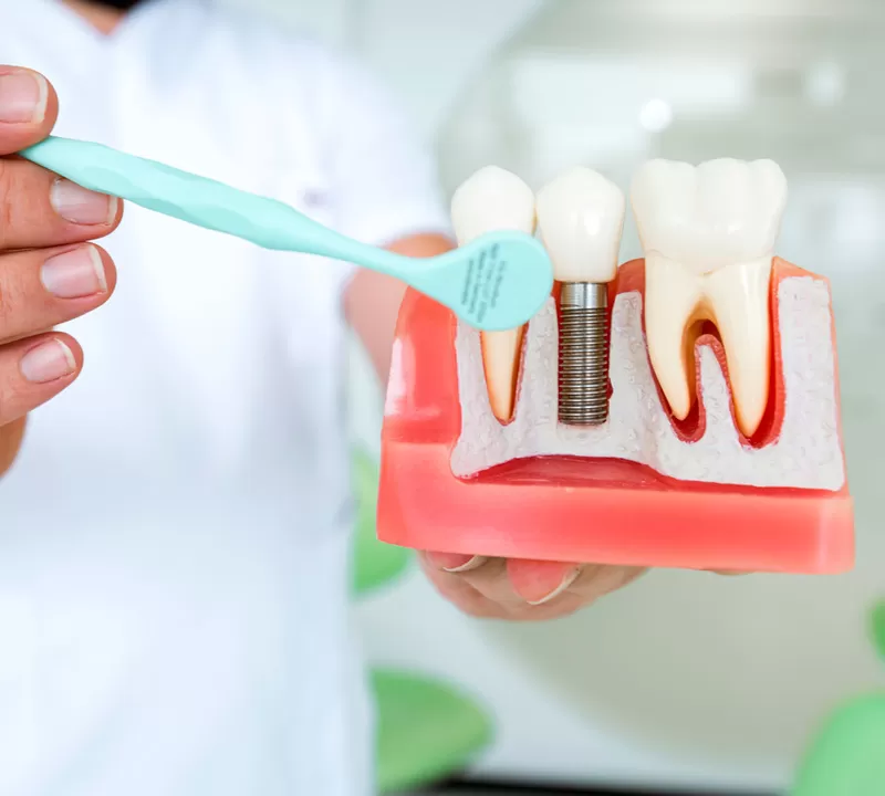 Cuidar De Um Implante Dentario.jpg